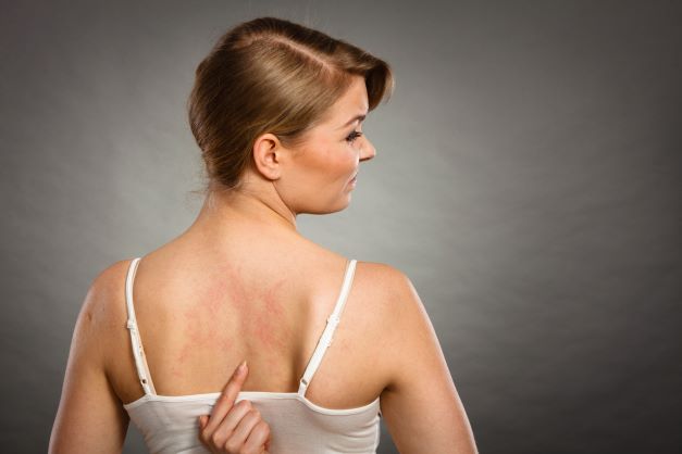 Žena otočená chrbtom ku objektívu má na sebe biele tielko a na chrbte ukazuje začervenanú kožu.