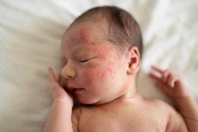 Novorodeniatko leží na bielej perinke, má zavreté oči, pravú ruku má položenú na tvári, na ľavej strane tváre ma červené fliačky, akné.