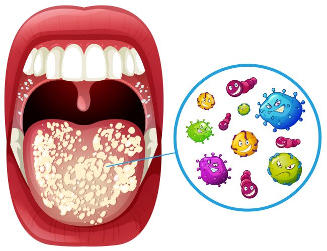 Ilustrácia otvorenej ústnej dutiny, na jazyku je biely povlak a ilustrované baktérie.
