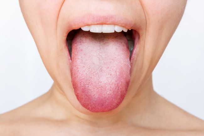 Ženský jazyk s bielym plakom. Orezaný záber mladej ženy ukazujúcej jazyk izolovaný na bielom pozadí. Ochorenie tráviaceho traktu, dysfunkcia orgánov, zlá ústna hygiena, plesňové infekcie