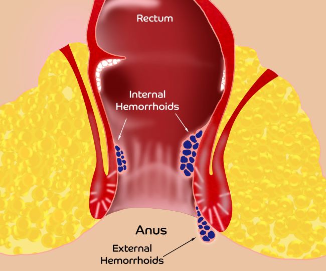 Ilustrácia vonkajšie hemoroidy a vnútorné hemoroidy.