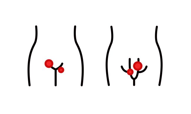 Genitálny herpes, ikonka mužského a ženského genitálneho oparu vyznačený červenou farbou na miestach postihnutia.