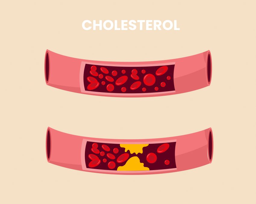 Normalna a cholesterolom blokovaná tepna. Masticha na žalúdok