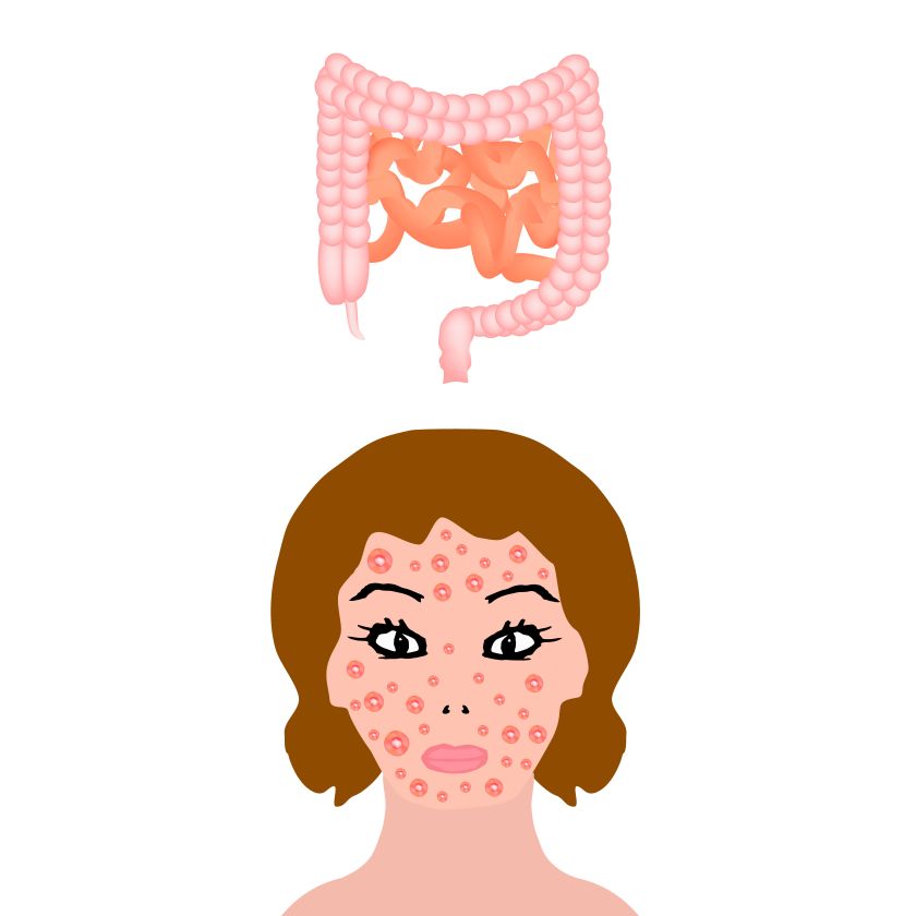 Anatomická štruktúra čreva. Črevné ochorenia postihujú kožu. Zápal kože a akné. Vektorové ilustrácie na izolovanom pozadí. Masticha v kozmetike