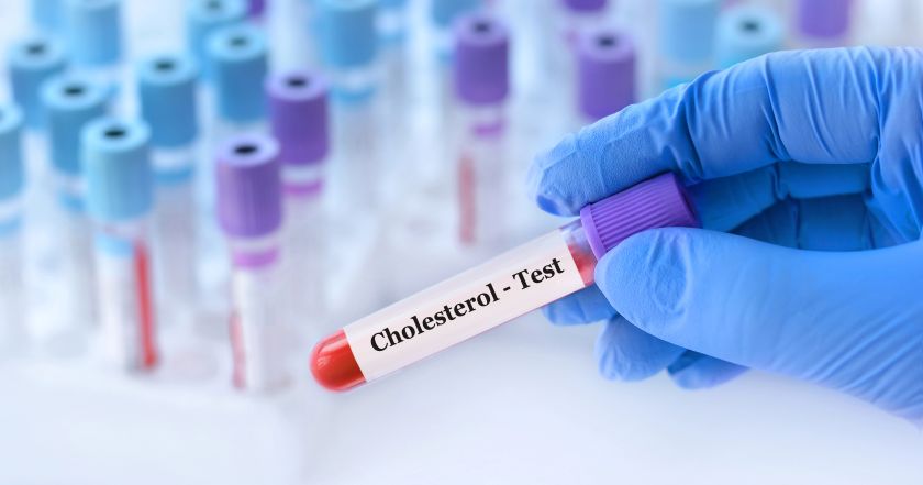 Doktor drží skúmavku so vzorkou krvi s Cholesterol testom na pozadí lekárskej skúmavky s analýzami. Masticha chios, masticha cholesterol a travenie