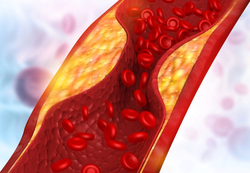 Upchatá tepna, arterialny plak. Masticha Chios cholesterol a travenie
